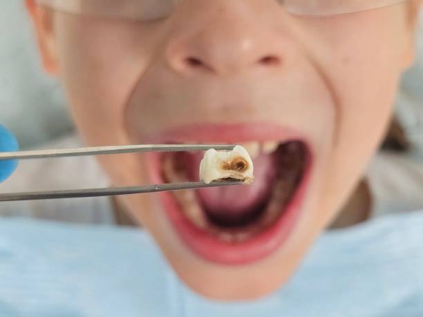 Best Knocked-Out Tooth (Avulsed Tooth) Treatment in Niles, MI